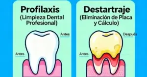 Limpieza-dental-profilaxis