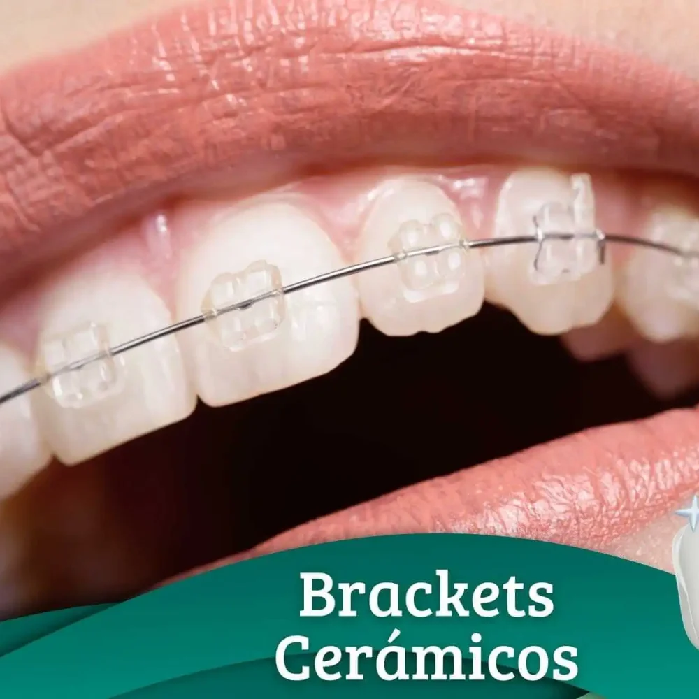 brackets-cerámicos